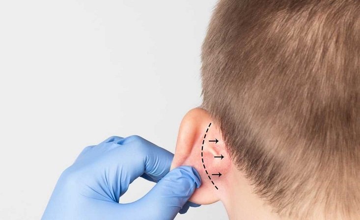 Kepçe Kulak Ameliyatı Ne Zaman Ve Kaç Yaşında Yapılır?