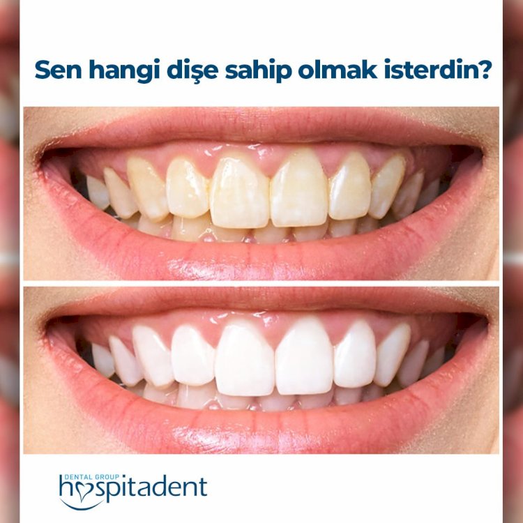 BEYAZ VE SAĞLIKLI GÜLÜŞLER ARTIK HAYAL DEĞİL!
