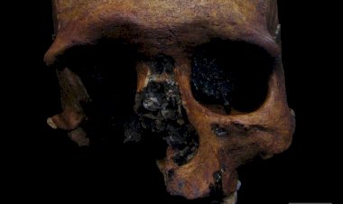 Roma Dönemi’ne Ait Bir Kafatasında Tümör Belirlendi