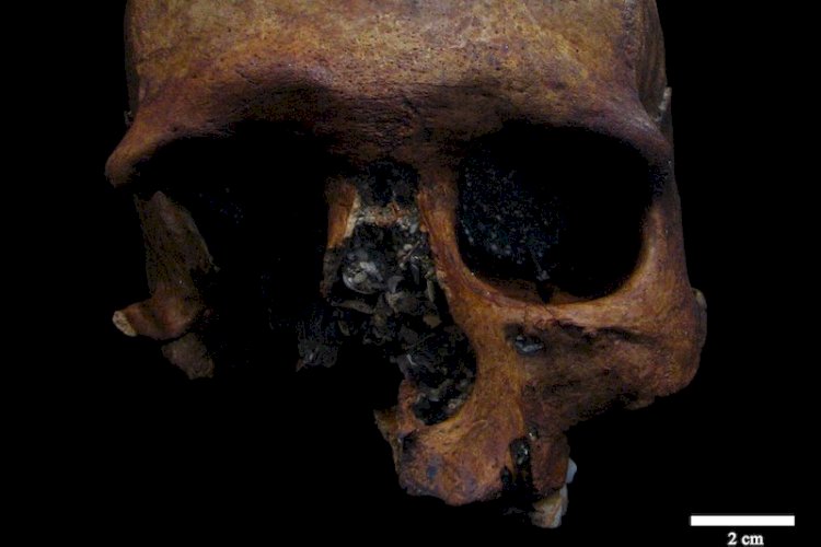 Roma Dönemi’ne Ait Bir Kafatasında Tümör Belirlendi